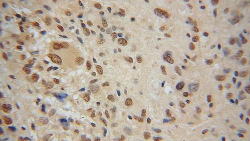 Immunohistochemical of paraffin-embedded human gliomas using Catalog No:117241(POU3F2 antibody) at dilution of 1:100 (under 40x lens)