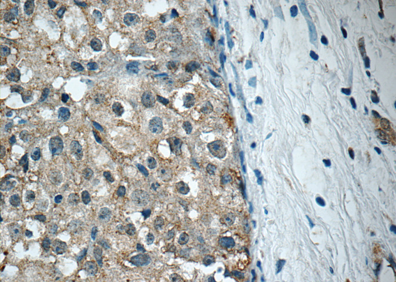 Immunohistochemistry of paraffin-embedded human breast cancer tissue slide using Catalog No:114837(RPS26 Antibody) at dilution of 1:50 (under 40x lens)