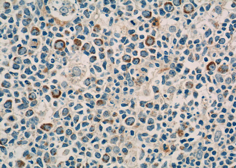 Immunohistochemistry of paraffin-embedded human tonsillitis tissue slide using Catalog No:109149(KLRD1 Antibody) at dilution of 1:50 (under 40x lens)