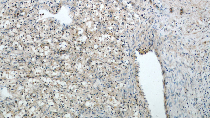 Immunohistochemical of paraffin-embedded human renal cell carcinoma using Catalog No:116009(TFEB antibody) at dilution of 1:50 (under 10x lens)