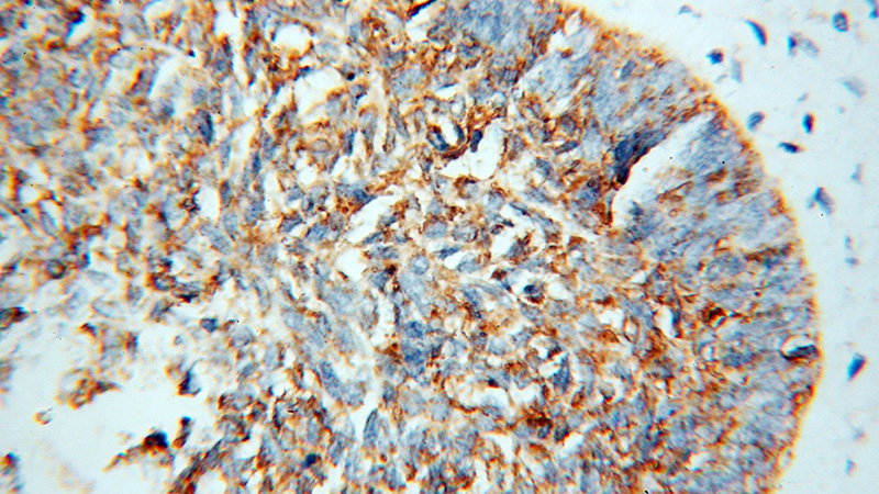 Immunohistochemical of paraffin-embedded human skin cancer using Catalog No:113286(NSDHL antibody) at dilution of 1:100 (under 40x lens)