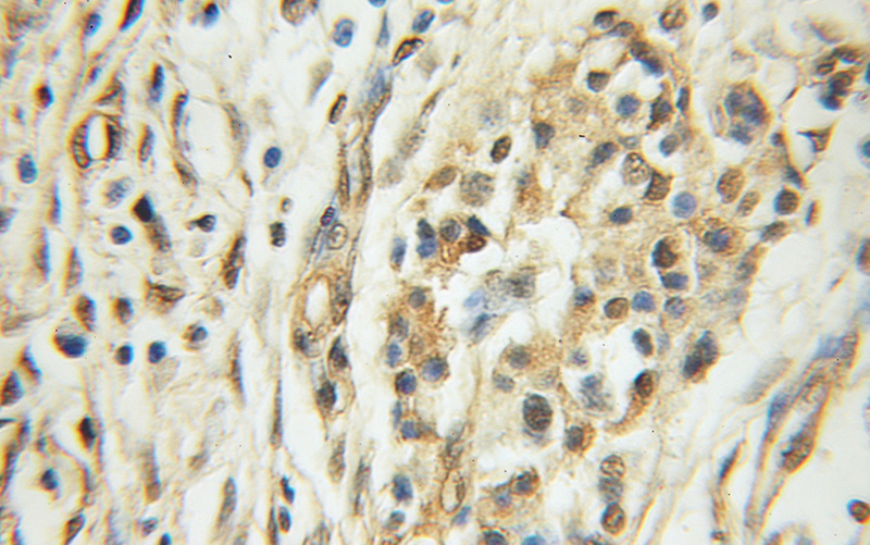 Immunohistochemical of paraffin-embedded human pancreas cancer using Catalog No:108185(ARHGEF18 antibody) at dilution of 1:50 (under 10x lens)