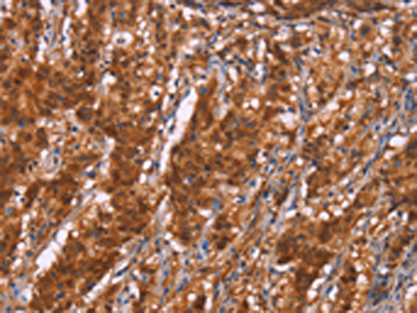 The image is immunohistochemistry of paraffin-embedded Human gastric cancer tissue using 167526(BRK1 Antibody) at dilution 1/40, on the right is treated with synthetic peptide. (Original magnification: ×200)
