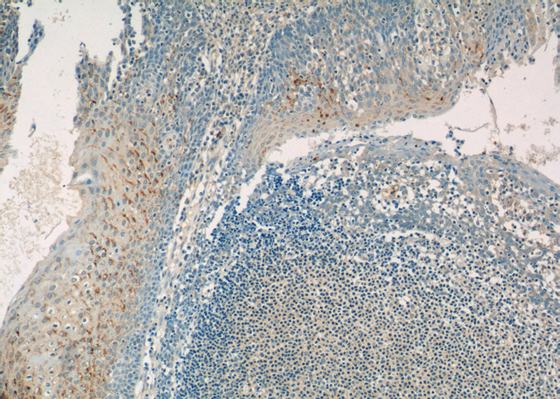 Immunohistochemistry of paraffin-embedded human tonsillitis tissue slide using Catalog No:111167(GSG1L Antibody) at dilution of 1:50 (under 10x lens)