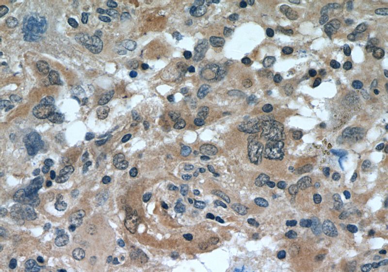 Immunohistochemistry of paraffin-embedded human gliomas tissue slide using Catalog No:112389(MAGED1 Antibody) at dilution of 1:100 (under 40x lens)
