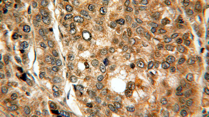 Immunohistochemical of paraffin-embedded human liver cancer using Catalog No:114283(PRUNE antibody) at dilution of 1:100 (under 40x lens)