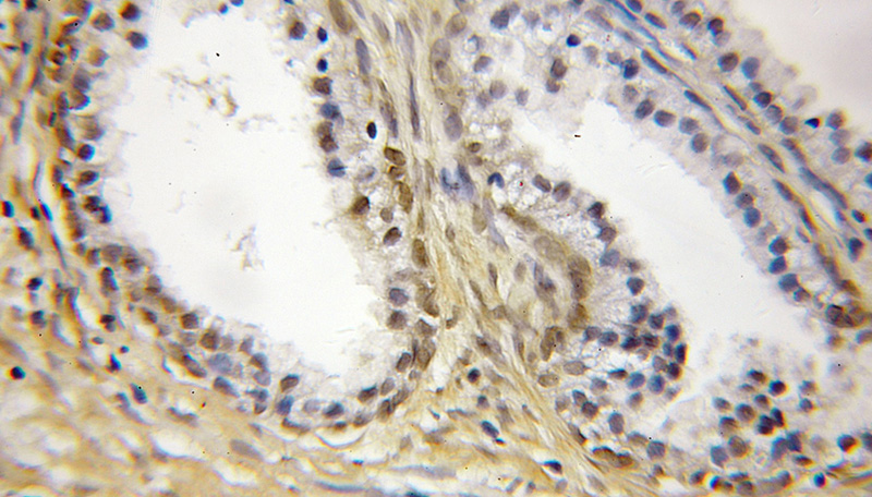 Immunohistochemical of paraffin-embedded human prostate cancer using Catalog No:115604(SS18L2 antibody) at dilution of 1:50 (under 25x lens)