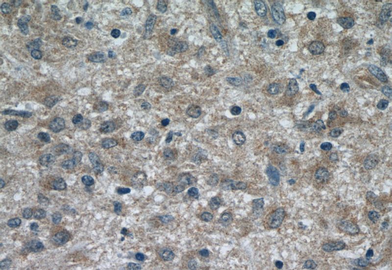 Immunohistochemistry of paraffin-embedded human gliomas tissue slide using Catalog No:114464(RAB9A-Specific Antibody) at dilution of 1:50