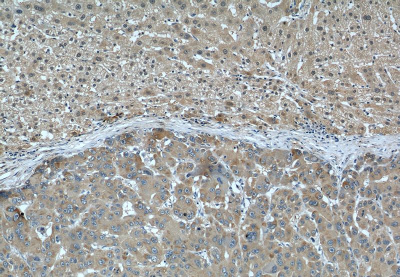 Immunohistochemical of paraffin-embedded human liver cancer using Catalog No:107054(AGT antibody) at dilution of 1:50 (under 10x lens)