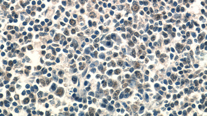 Immunohistochemistry of paraffin-embedded human tonsillitis tissue slide using Catalog No:107937(AKNA Antibody) at dilution of 1:50 (under 40x lens)