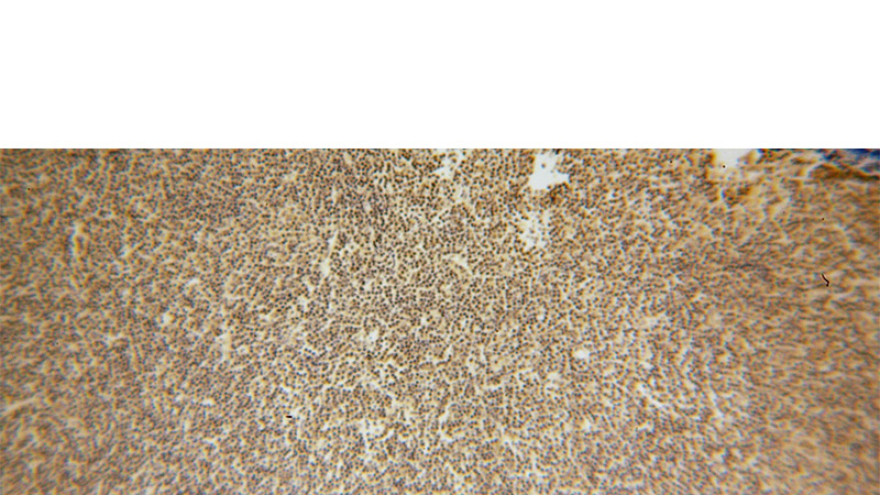 Immunohistochemical of paraffin-embedded human lymphoma using Catalog No:111212(ADRBK1 antibody) at dilution of 1:100 (under 10x lens)