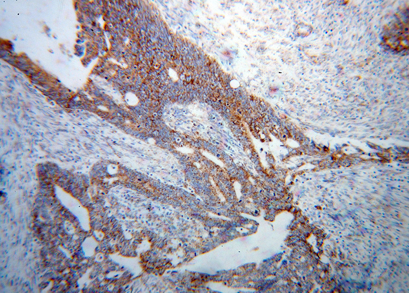 Immunohistochemical of paraffin-embedded human liver cancer using Catalog No:112543(MCCC1 antibody) at dilution of 1:100 (under 10x lens)