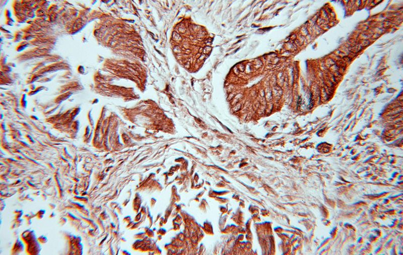 Immunohistochemical of paraffin-embedded human colon cancer using Catalog No:115837(SUMO2/3 antibody) at dilution of 1:100 (under 10x lens)