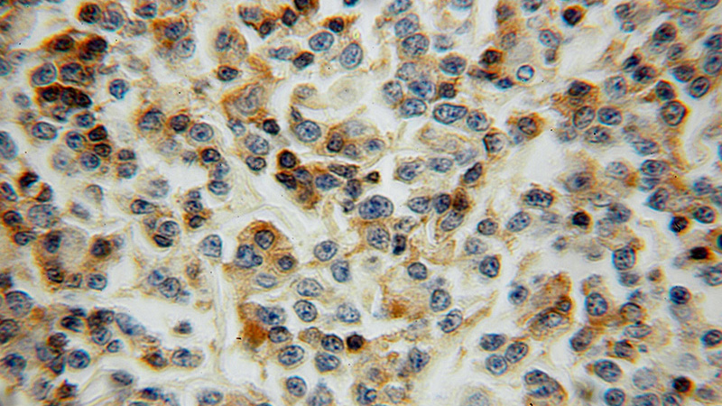 Immunohistochemical of paraffin-embedded human lymphoma using Catalog No:112306(LCP1 antibody) at dilution of 1:50 (under 10x lens)