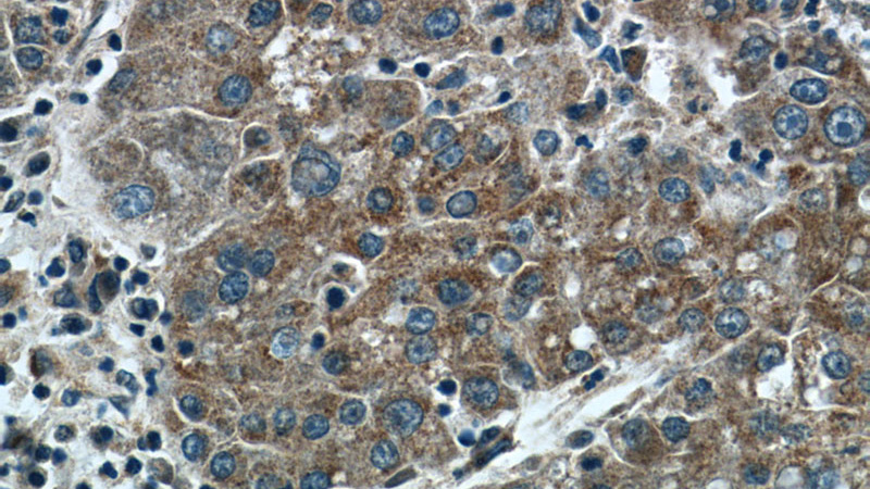 Immunohistochemistry of paraffin-embedded human liver cancer tissue slide using Catalog No:112098(KLHL21 Antibody) at dilution of 1:50 (under 40x lens)