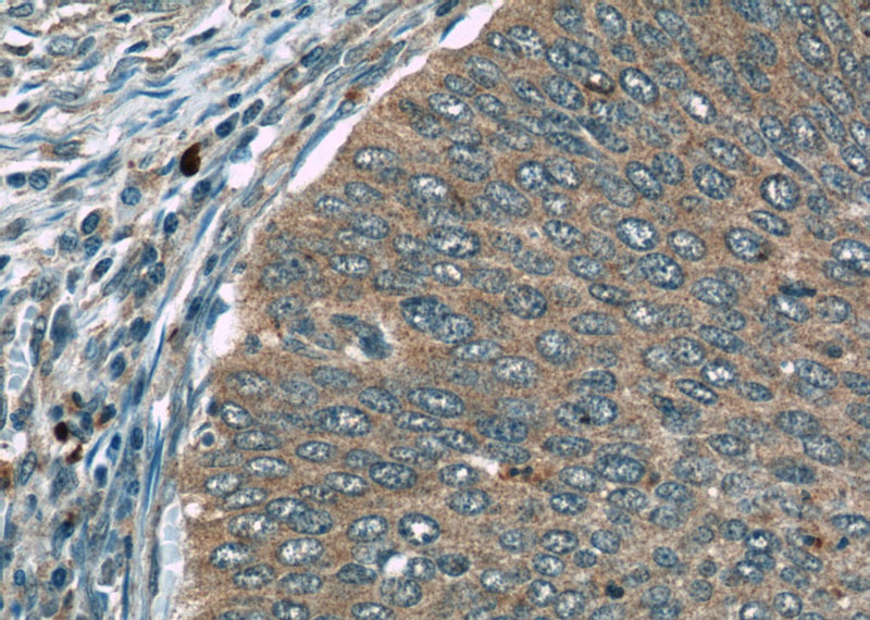 Immunohistochemistry of paraffin-embedded human cervical cancer slide using Catalog No:110577(FAM168B Antibody) at dilution of 1:50 (under 40x lens)