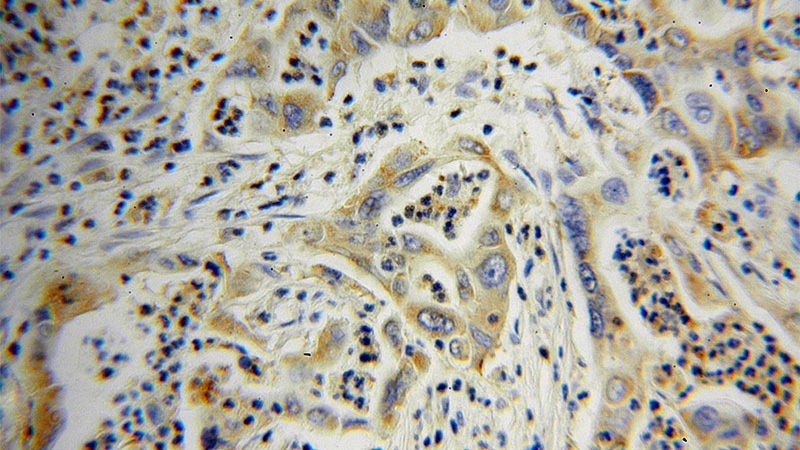Immunohistochemical of paraffin-embedded human pancreas cancer using Catalog No:107361(KEAP1 antibody) at dilution of 1:100 (under 40x lens)