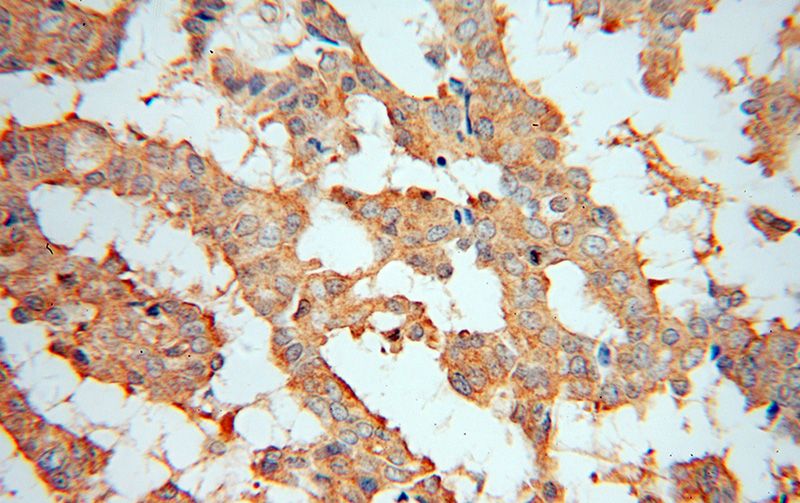 Immunohistochemical of paraffin-embedded human breast cancer using Catalog No:113472(PA2G4 antibody) at dilution of 1:100 (under 40x lens)