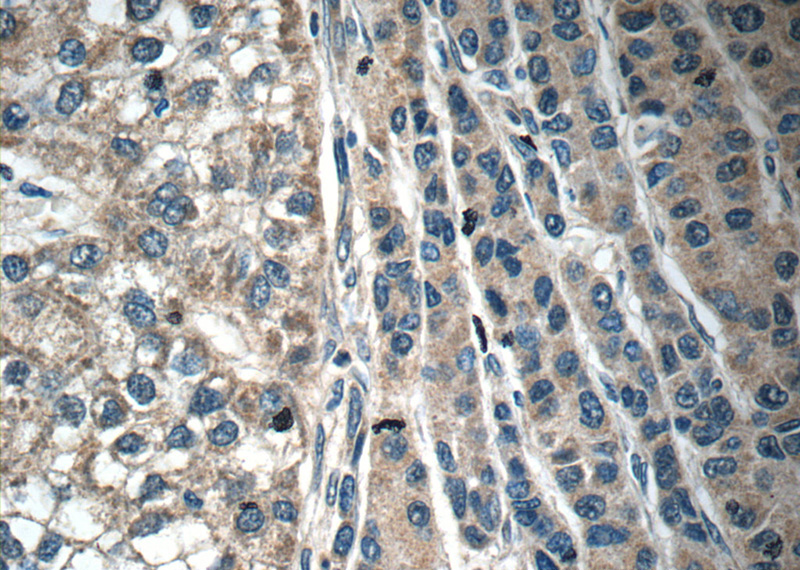 Immunohistochemistry of paraffin-embedded human liver cancer tissue slide using Catalog No:108739(C6 Antibody) at dilution of 1:50 (under 40x lens)