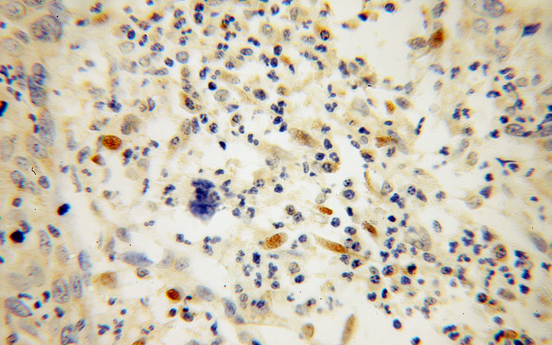Immunohistochemical of paraffin-embedded human cervical cancer using Catalog No:114990(SCEL antibody) at dilution of 1:100 (under 40x lens)