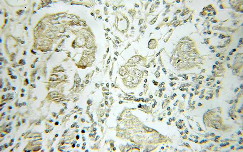Immunohistochemical of paraffin-embedded human breast cancer using Catalog No:108394(B4GALT3 antibody) at dilution of 1:50 (under 10x lens)