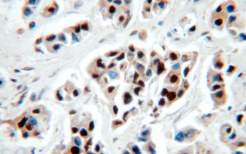 Immunohistochemical of paraffin-embedded human breast cancer using Catalog No:113388(NSUN2 antibody) at dilution of 1:100 (under 40x lens)