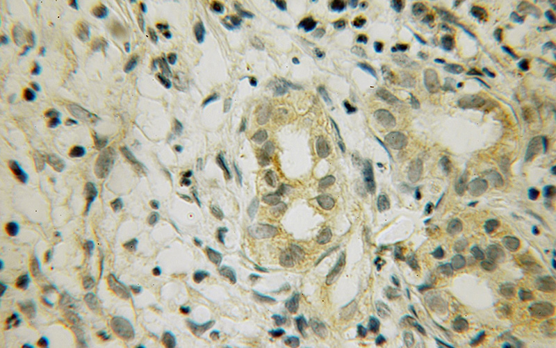 Immunohistochemical of paraffin-embedded human pancreas cancer using Catalog No:110779(FRZB antibody) at dilution of 1:100 (under 10x lens)