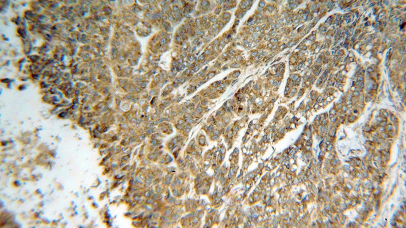 Immunohistochemical of paraffin-embedded human lung cancer using Catalog No:110375(PDIA4 antibody) at dilution of 1:100 (under 10x lens)