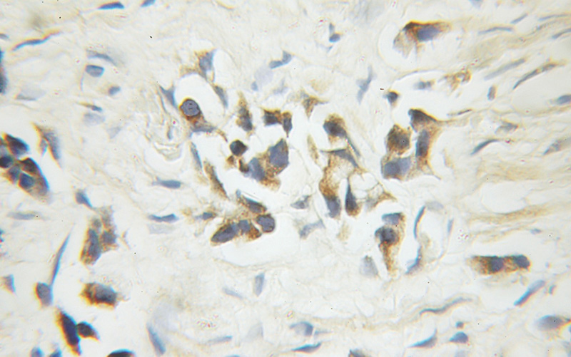 Immunohistochemical of paraffin-embedded human prostate cancer using Catalog No:108878(CASP6 antibody) at dilution of 1:50 (under 10x lens)