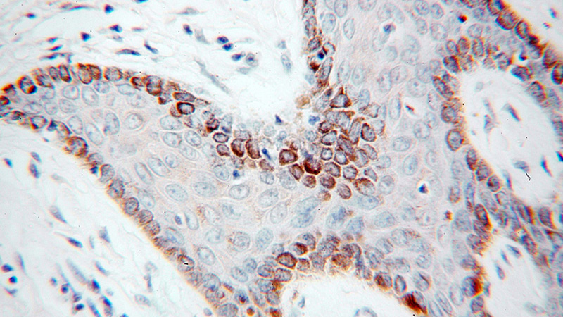 Immunohistochemical of paraffin-embedded human skin cancer using Catalog No:109592(UNR; CSDE1 antibody) at dilution of 1:50 (under 40x lens)