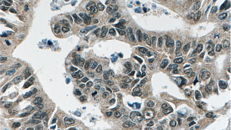 Immunohistochemistry of paraffin-embedded human pancreas cancer tissue slide using Catalog No:107307(GSNOR,ADH5 Antibody) at dilution of 1:50 (under 40x lens)