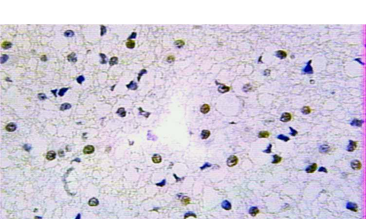Immunohistochemical of paraffin-embedded human gliomas using Catalog No:114794(RPA2 antibody) at dilution of 1:100 (under 25x lens)