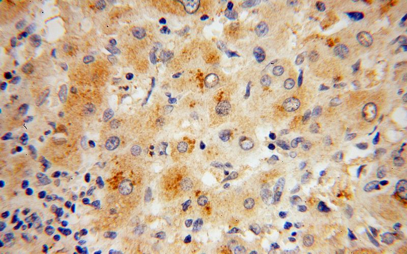 Immunohistochemical of paraffin-embedded human liver cancer using Catalog No:114883(RPL27 antibody) at dilution of 1:100 (under 40x lens)