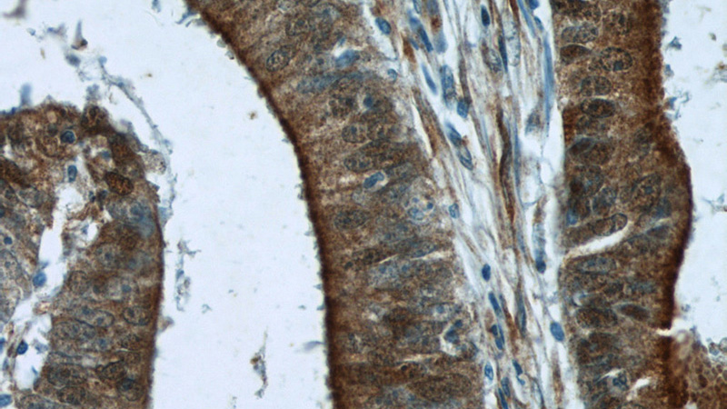 Immunohistochemistry of paraffin-embedded human colon cancer tissue slide using Catalog No:117093(B3GNT7 Antibody) at dilution of 1:50 (under 40x lens)
