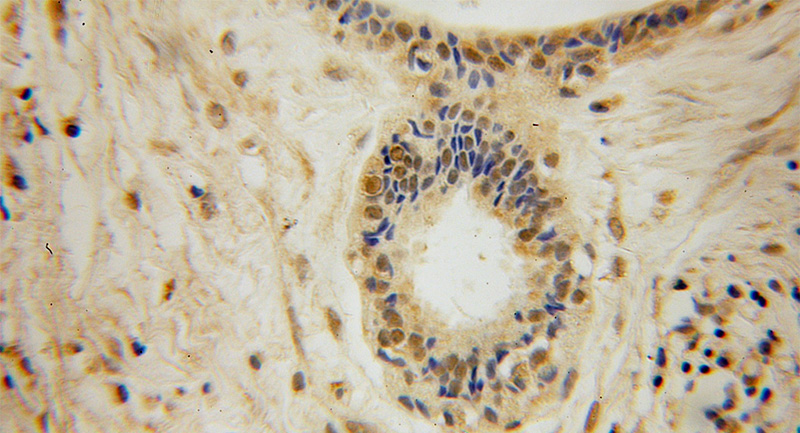 Immunohistochemical of paraffin-embedded human breast cancer using Catalog No:109905(DGCR8 antibody) at dilution of 1:100 (under 40x lens)