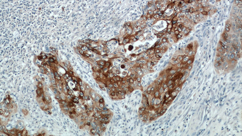 Immunohistochemical of paraffin-embedded human cervical cancer using Catalog No:109798(KRT17-Specific antibody) at dilution of 1:50 (under 10x lens)