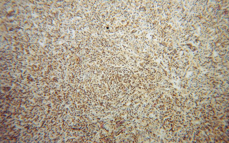Immunohistochemical of paraffin-embedded human lymphoma using Catalog No:114694(RIAM,APBB1IP antibody) at dilution of 1:100 (under 10x lens)
