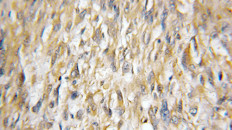 Immunohistochemical of paraffin-embedded human gliomas using Catalog No:116522(UBE2E2 antibody) at dilution of 1:50 (under 10x lens)