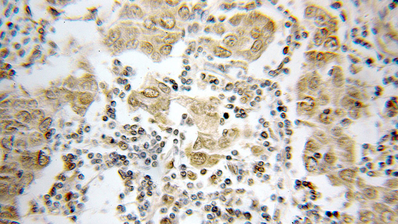 Immunohistochemical of paraffin-embedded human breast cancer using Catalog No:114384(PSMB4 antibody) at dilution of 1:50 (under 10x lens)