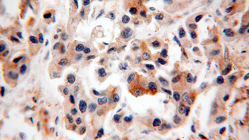Immunohistochemical of paraffin-embedded human breast cancer using Catalog No:115597(SRPR antibody) at dilution of 1:50 (under 40x lens)