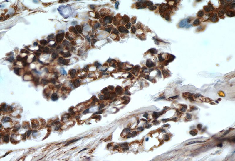 Immunohistochemistry of paraffin-embedded human ovary tumor tissue slide using Catalog No:111378(HDAC4-specific Antibody) at dilution of 1:50 (under 40x lens)