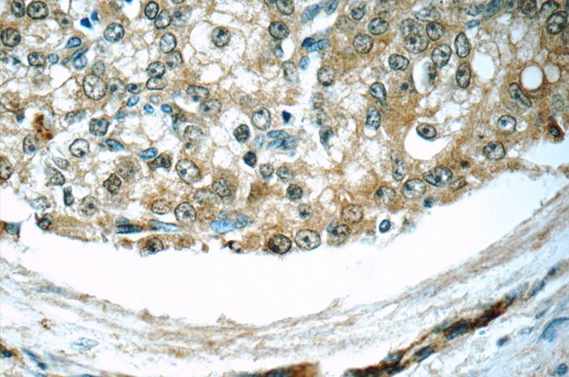 Immunohistochemistry of paraffin-embedded human prostate cancer tissue slide using Catalog No:109457(COPE Antibody) at dilution of 1:50 (under 40x lens)