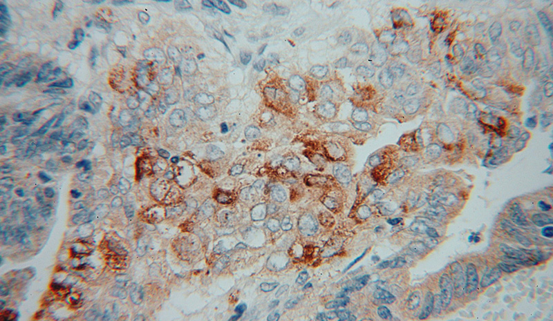 Immunohistochemical of paraffin-embedded human colon cancer using Catalog No:113923(PLA2G12A antibody) at dilution of 1:50 (under 40x lens)