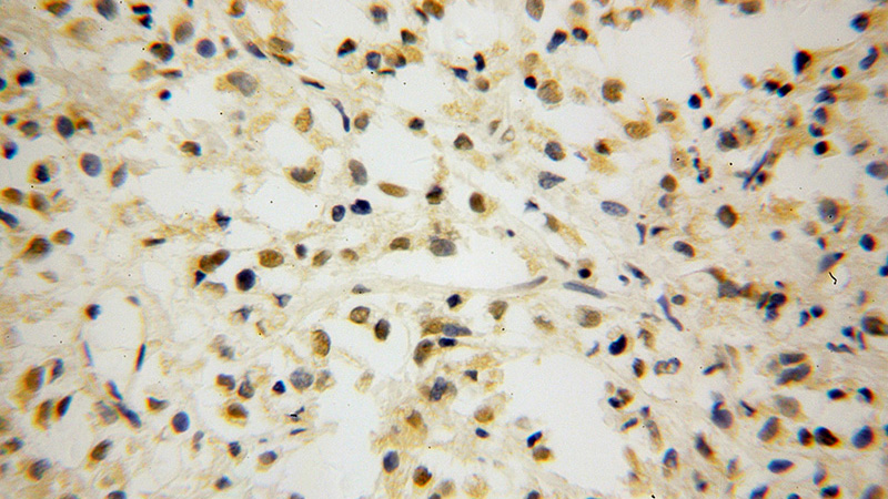 Immunohistochemical of paraffin-embedded human breast cancer using Catalog No:115907(TCF7L1 antibody) at dilution of 1:100 (under 40x lens)