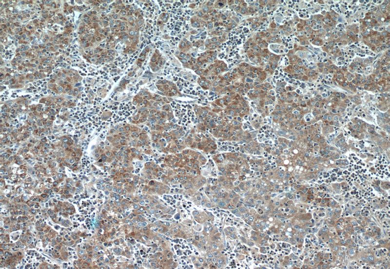 Immunohistochemistry of paraffin-embedded human liver cancer tissue slide using Catalog No:116110(TMEM182 Antibody) at dilution of 1:50 (under 10x lens)