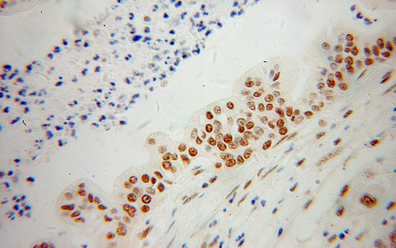 Immunohistochemical of paraffin-embedded human pancreas cancer using Catalog No:115148(SFRS17A antibody) at dilution of 1:100 (under 40x lens)