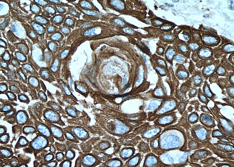 Immunohistochemistry of paraffin-embedded human oesophagus cancer tissue slide using Catalog No:107230(KRT15 Antibody) at dilution of 1:500 (under 40x lens).