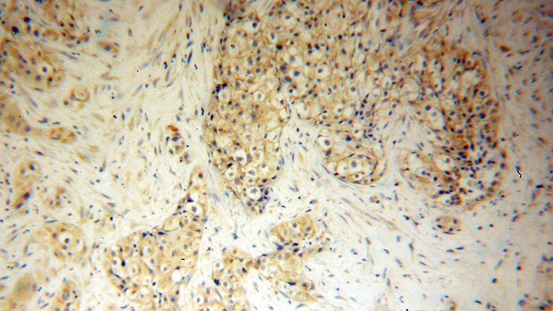Immunohistochemical of paraffin-embedded human lung cancer using Catalog No:115239(SIRPB1 antibody) at dilution of 1:50 (under 10x lens)