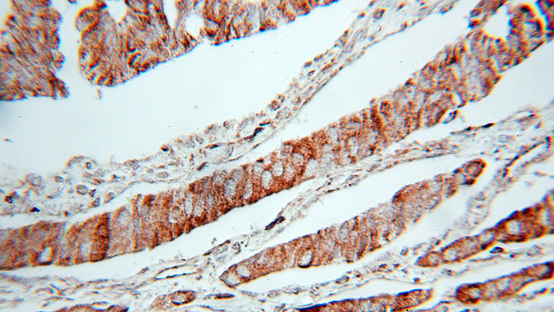 Immunohistochemical of paraffin-embedded human pancreas cancer using Catalog No:107923(AK2 antibody) at dilution of 1:50 (under 10x lens)