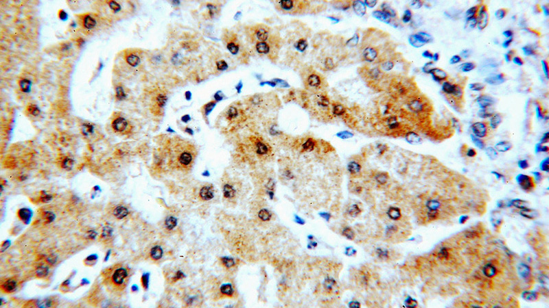 Immunohistochemical of paraffin-embedded human hepatocirrhosis using Catalog No:114497(RABGAP1L antibody) at dilution of 1:100 (under 40x lens)
